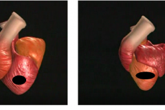 Heart-after-miocard-effect